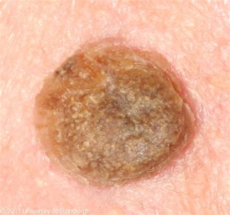 seborrheic keratosis icd 10